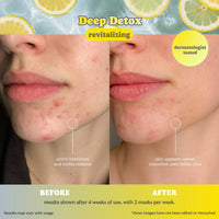 Bye Bye Breakouts Face Mask Kit